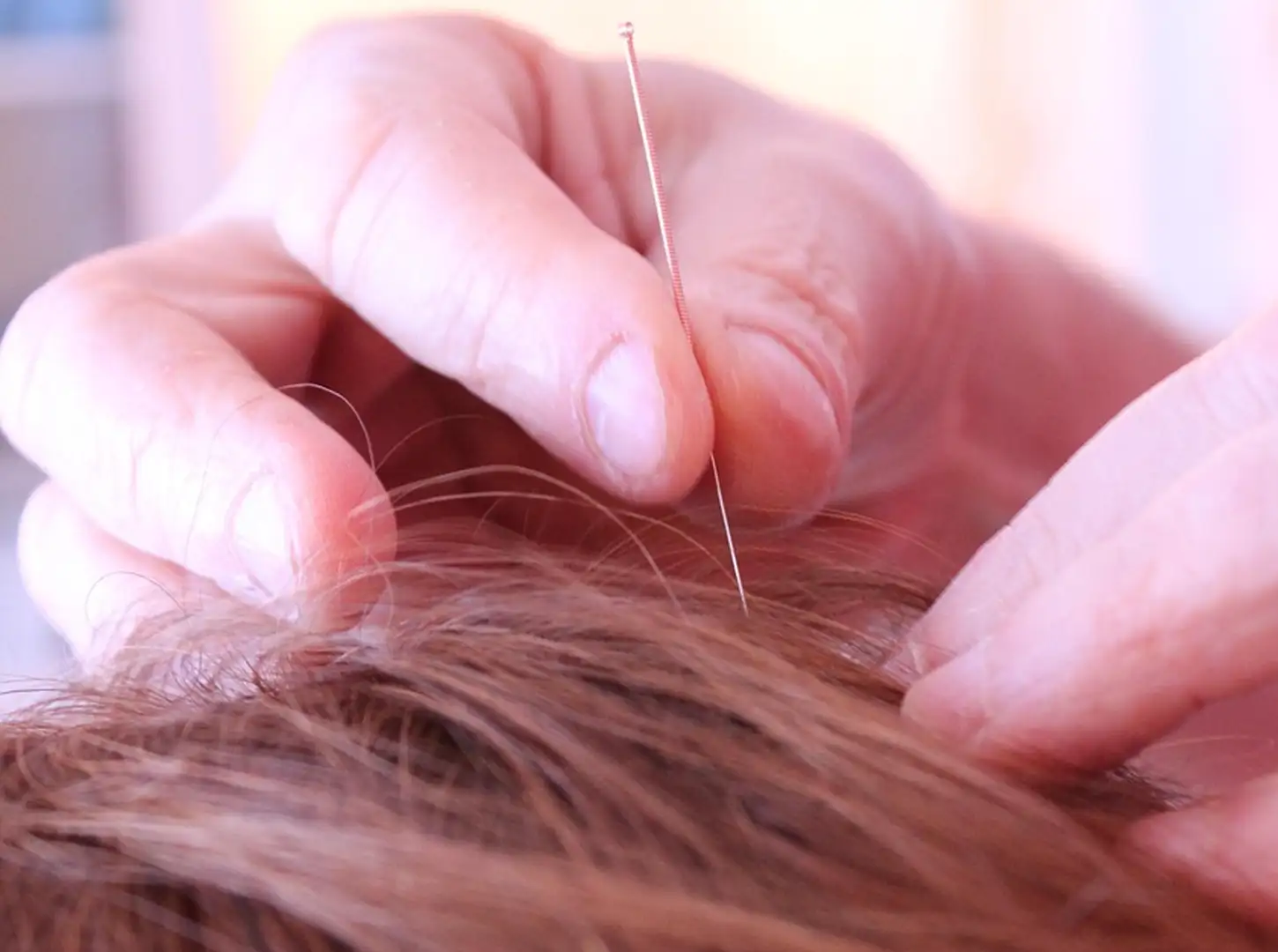 beneficios de la acupuntura shao fu acupuntura y MTC